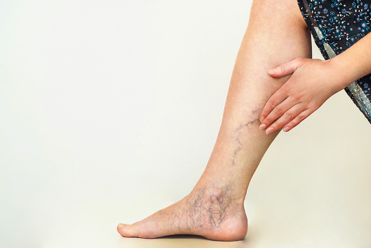 reducing_varicose_veins