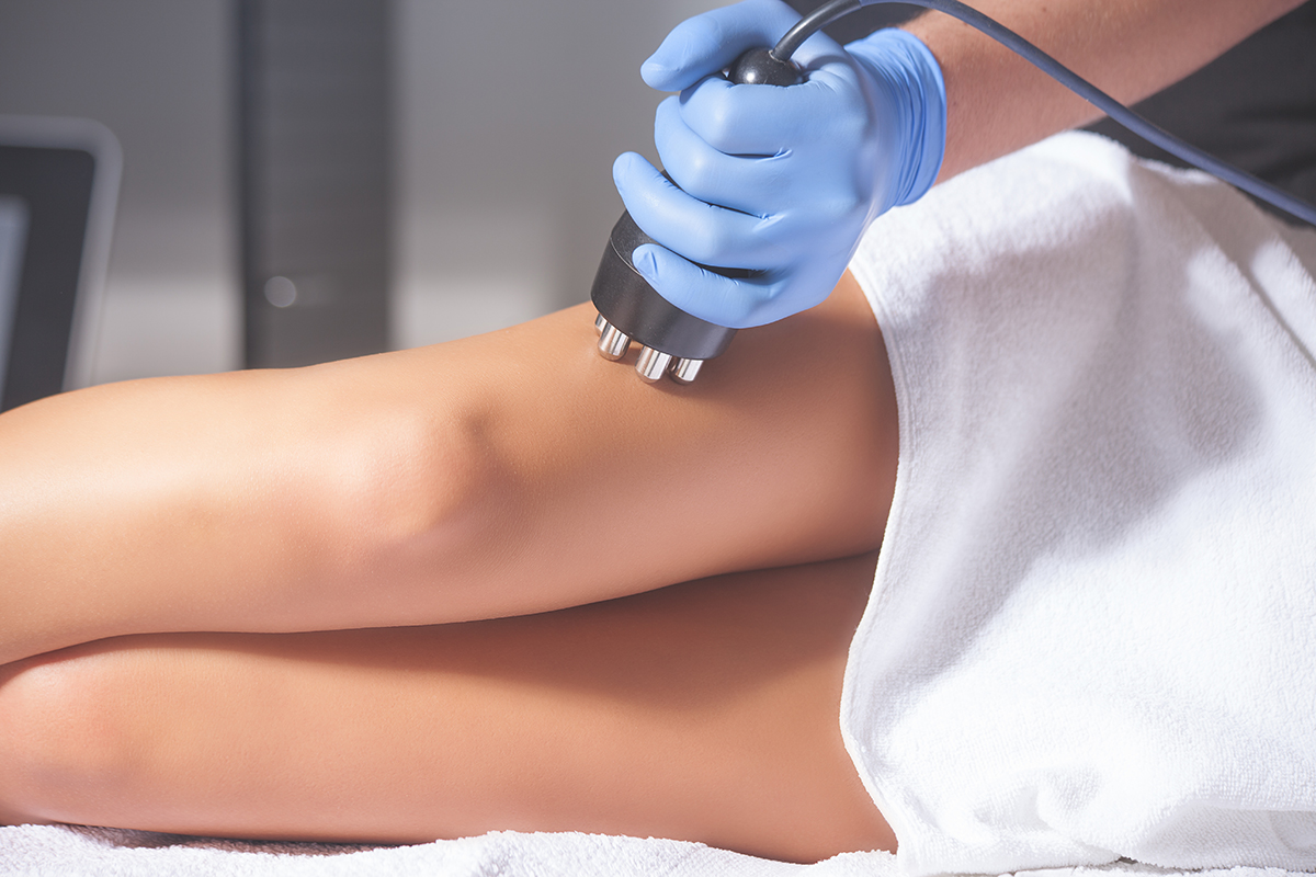 Which varicose vein treatment is best?