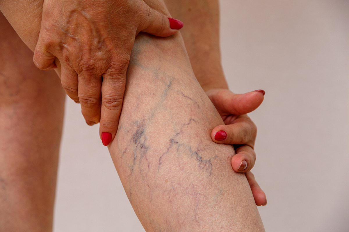 Dealing with Spider Veins on Ankles and Feet