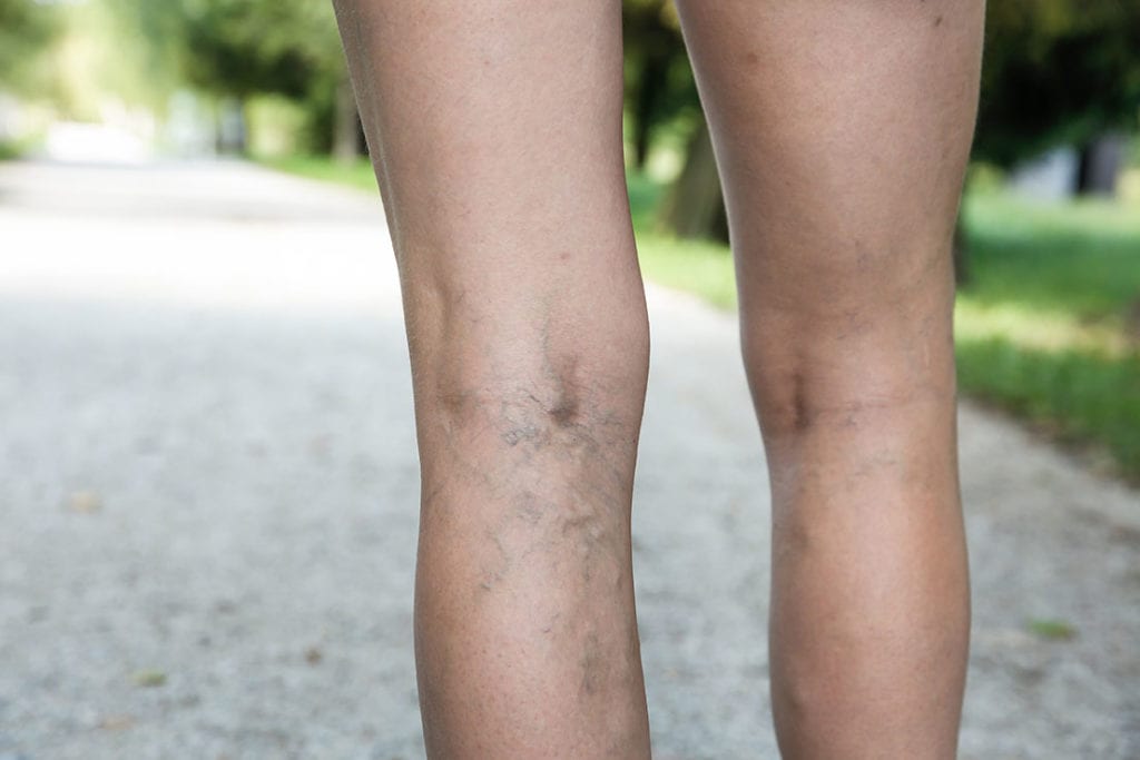 varicose veins in leg