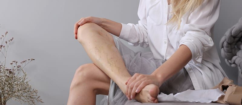 5 ways to care for varicose veins in winter
