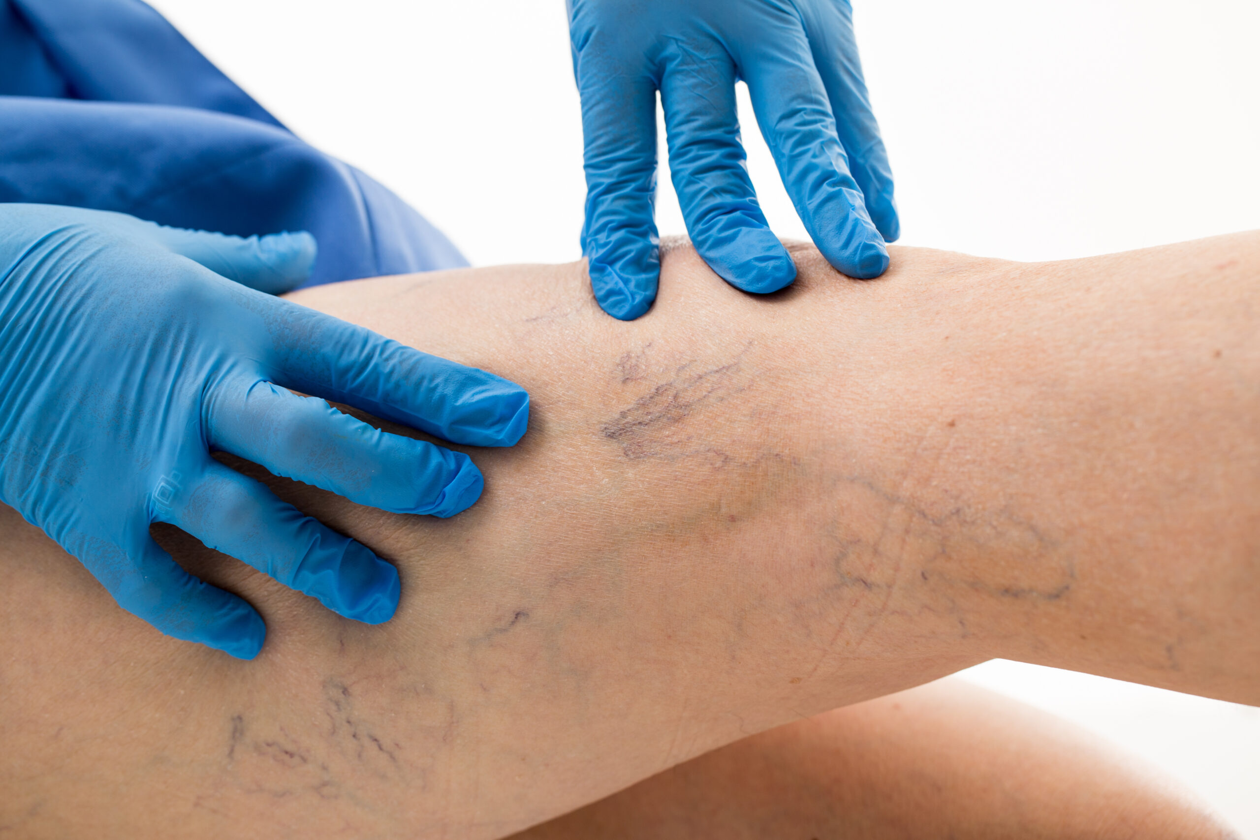 Varicose Veins & Venous Diseases - Vascular Info