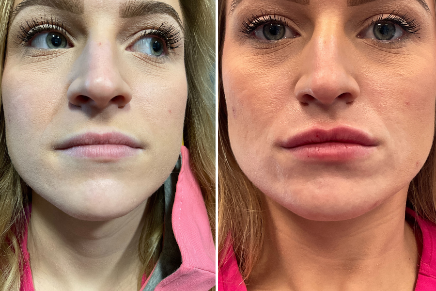 lips before and after
