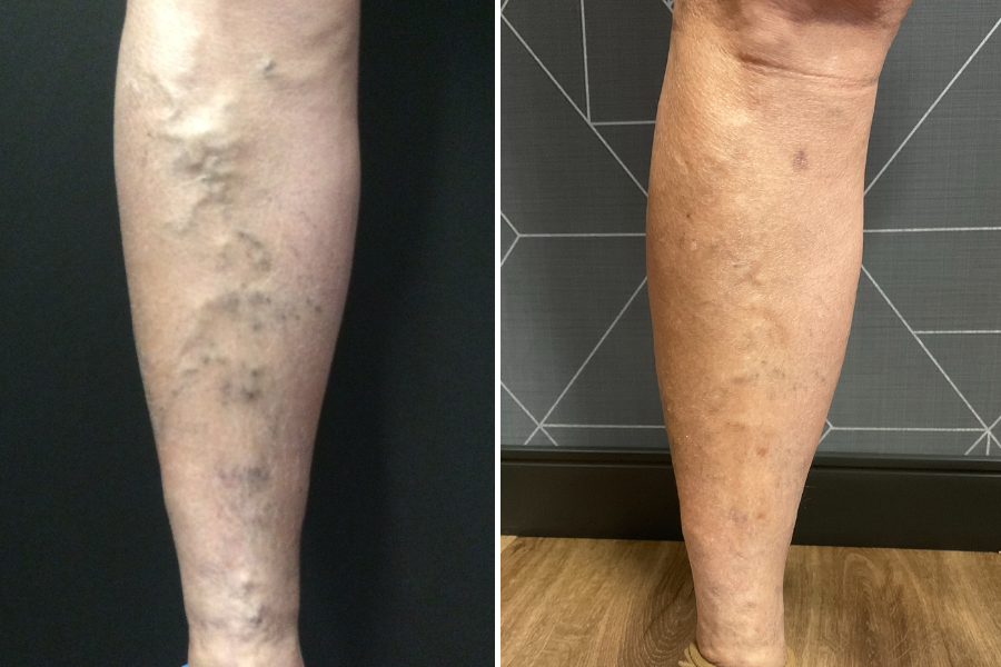 veins before and after