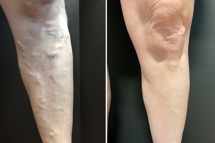 veins before and after