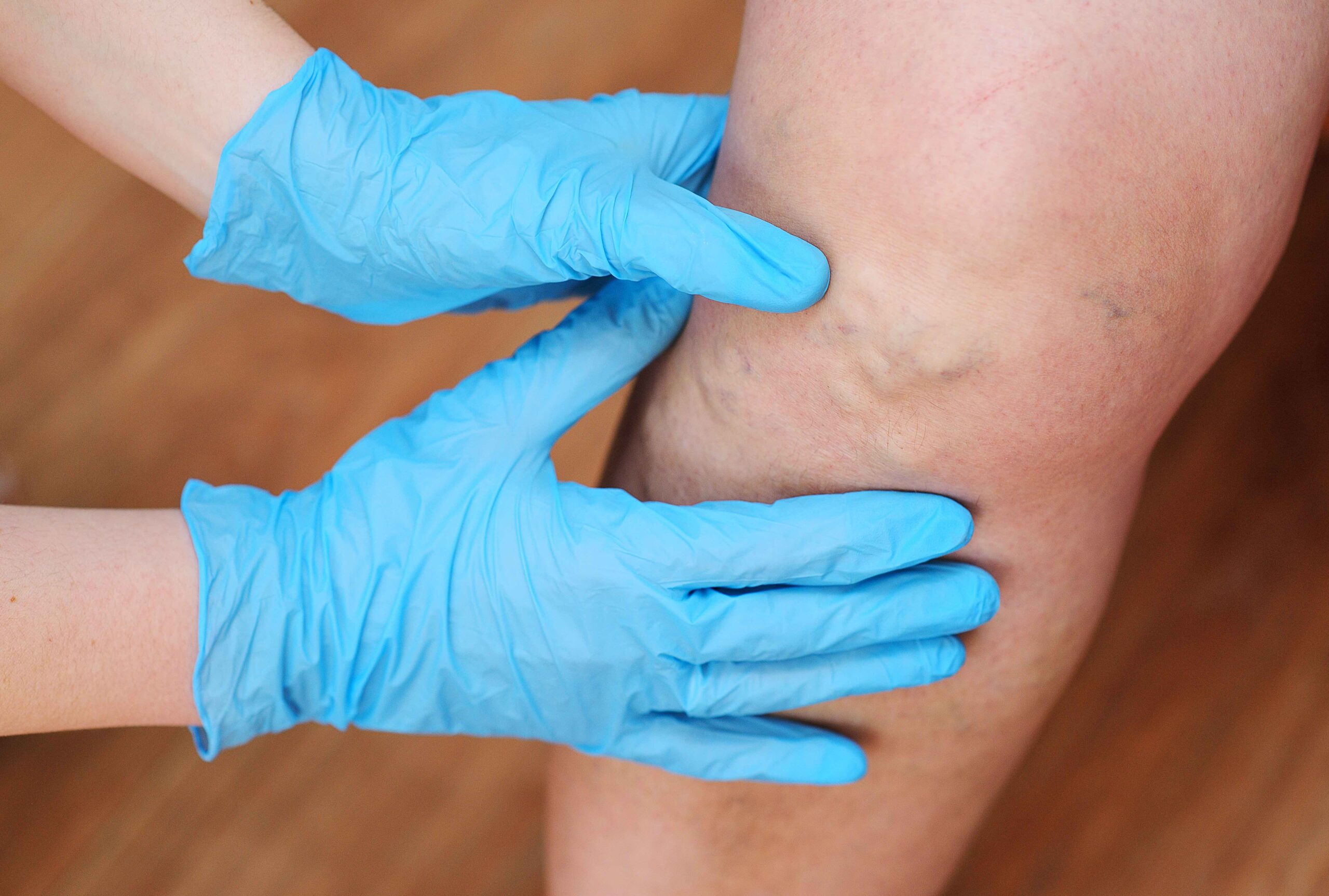 do varicose veins cause blood clots