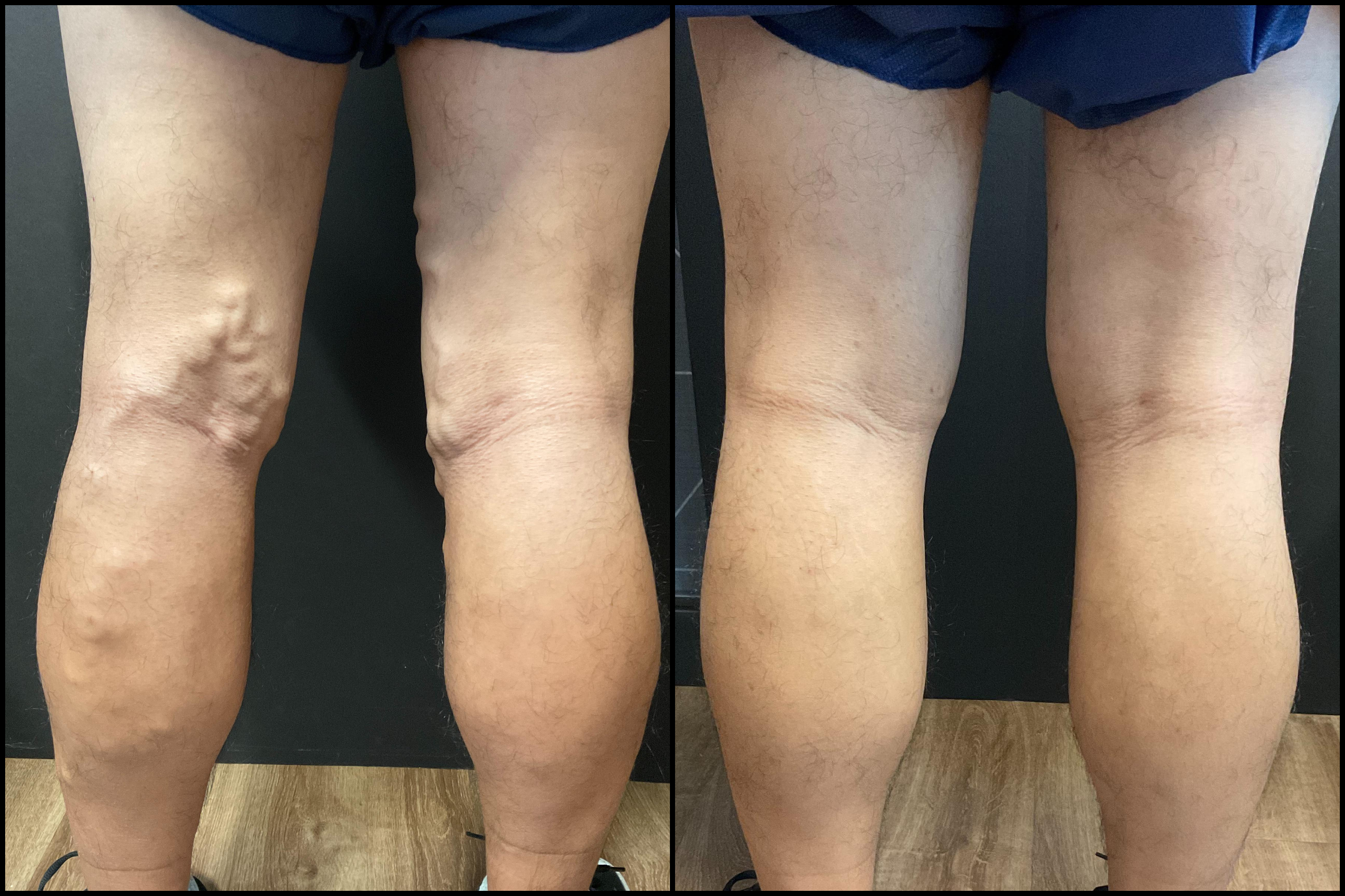 vein treatment before and after image