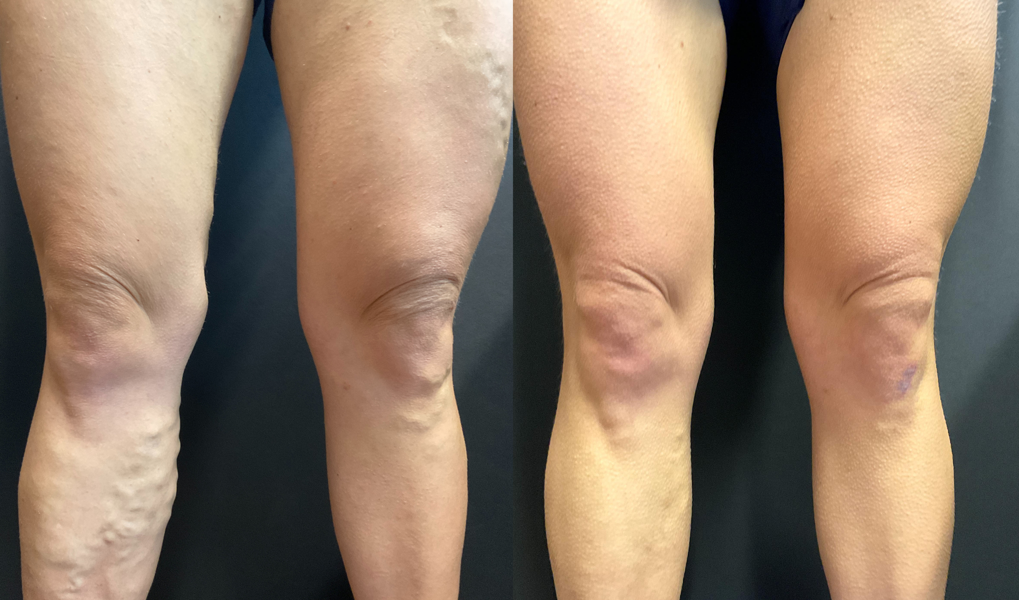 vein treatment before and after image