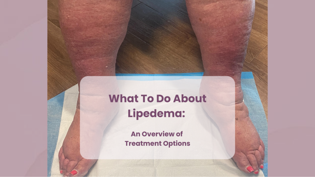 An image showing two legs of a patient suffering from lipidema with overlaid text that reads "What to Do About Lipidema: An Overview of Treatment Options"