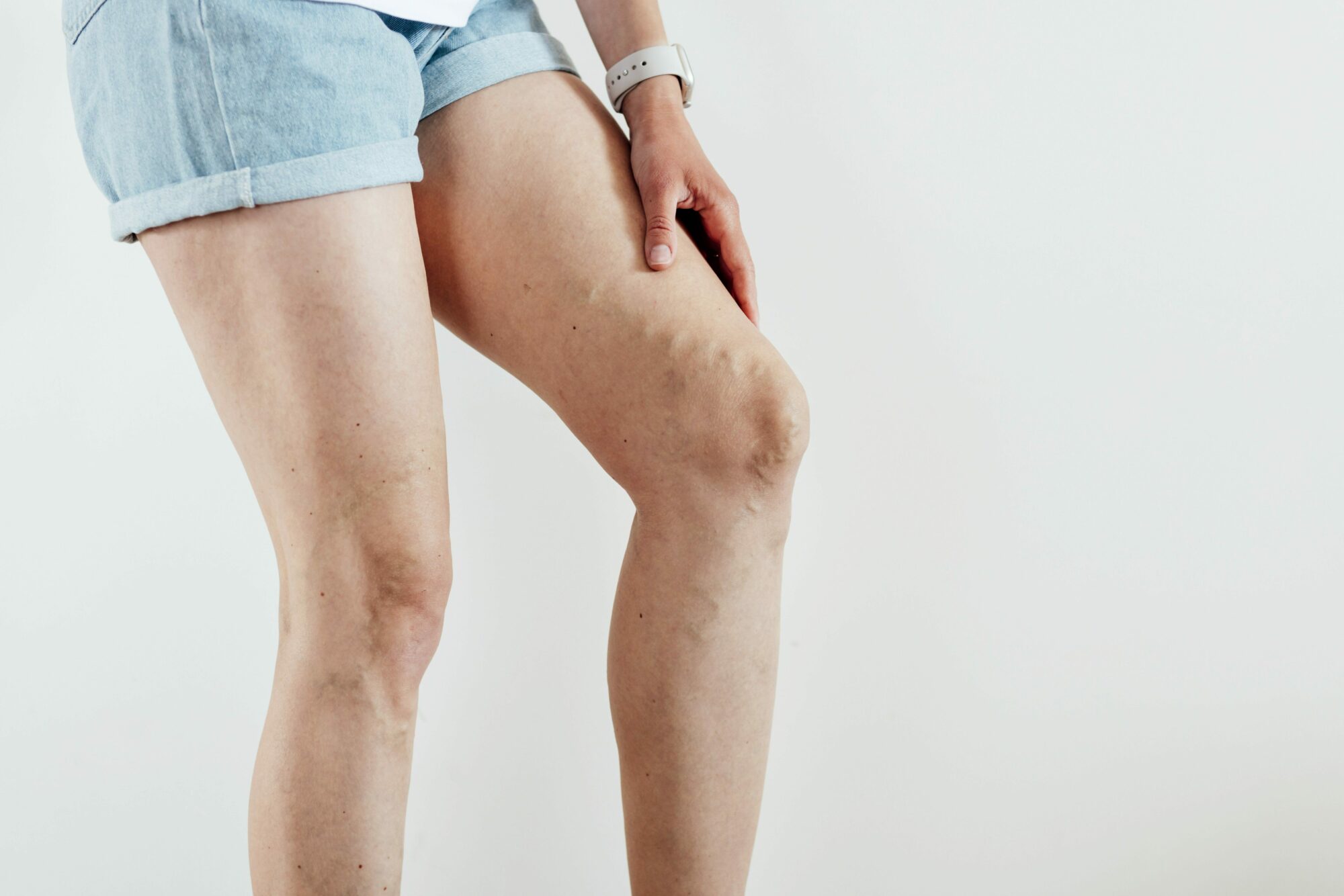 An image of a woman from the waist down holding her leg in pain. You can see varicose veins on her leg.