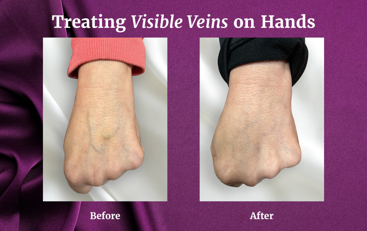 A Before and After Photo showing clear reduction of vein visibility in a hand after treatment